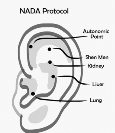 Ooracupunctuur NADA PROTOCOL